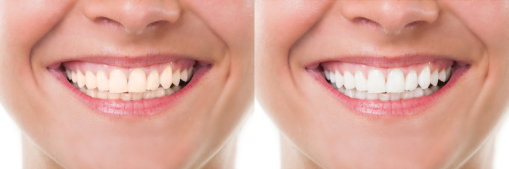 Before and after bleaching or whitening. Perfect woman mouth with teeth smile
