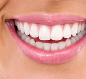 Perfect smile of a woman after teeth whitening in NYC.