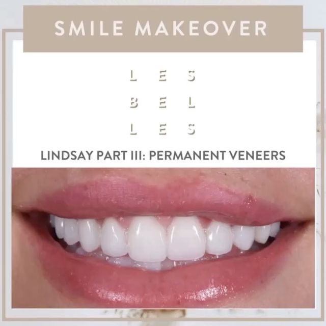 Les Belles Patient's Smile Makeover - Lindsay Part III: Permanent Veneers