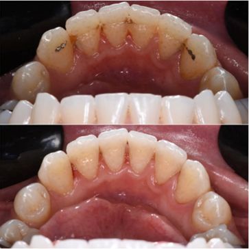 Teeth after removing traditional and lingual retainer.