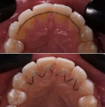 Traditional Retainer vs Lingual Retainer