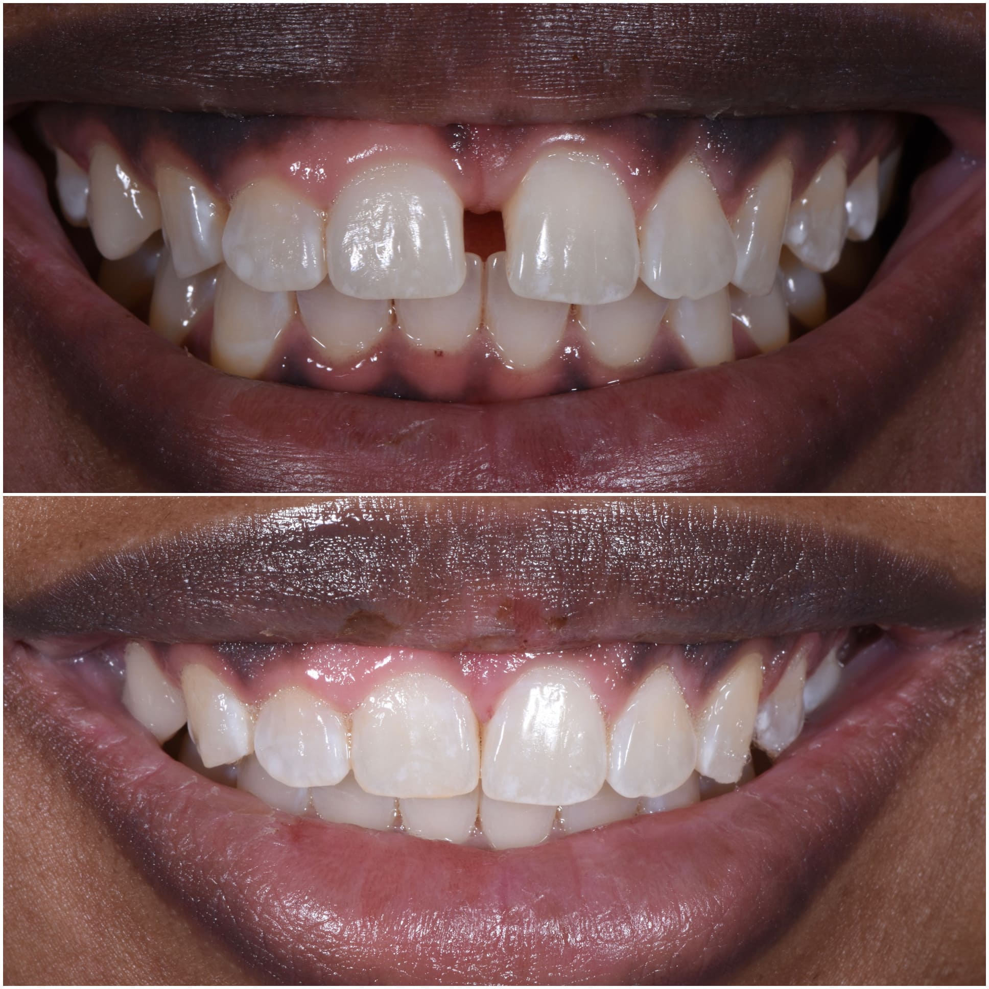 Teeth Before and After the Accelerated Orthodontics