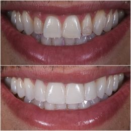 teeth before and after the procedure
