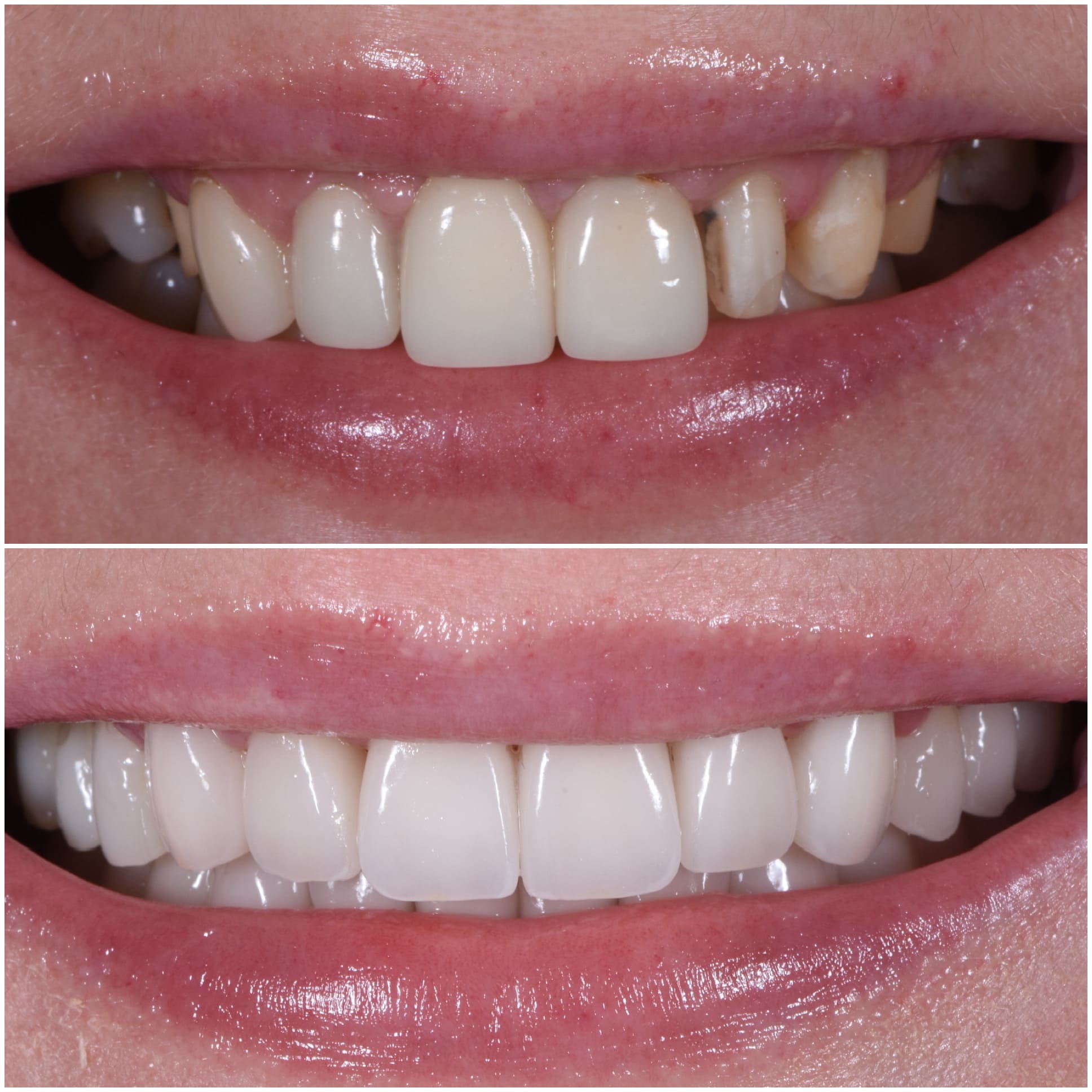 🥇 NYC Teeth Bonding  Upper East Side Cosmetic Dental Bonding