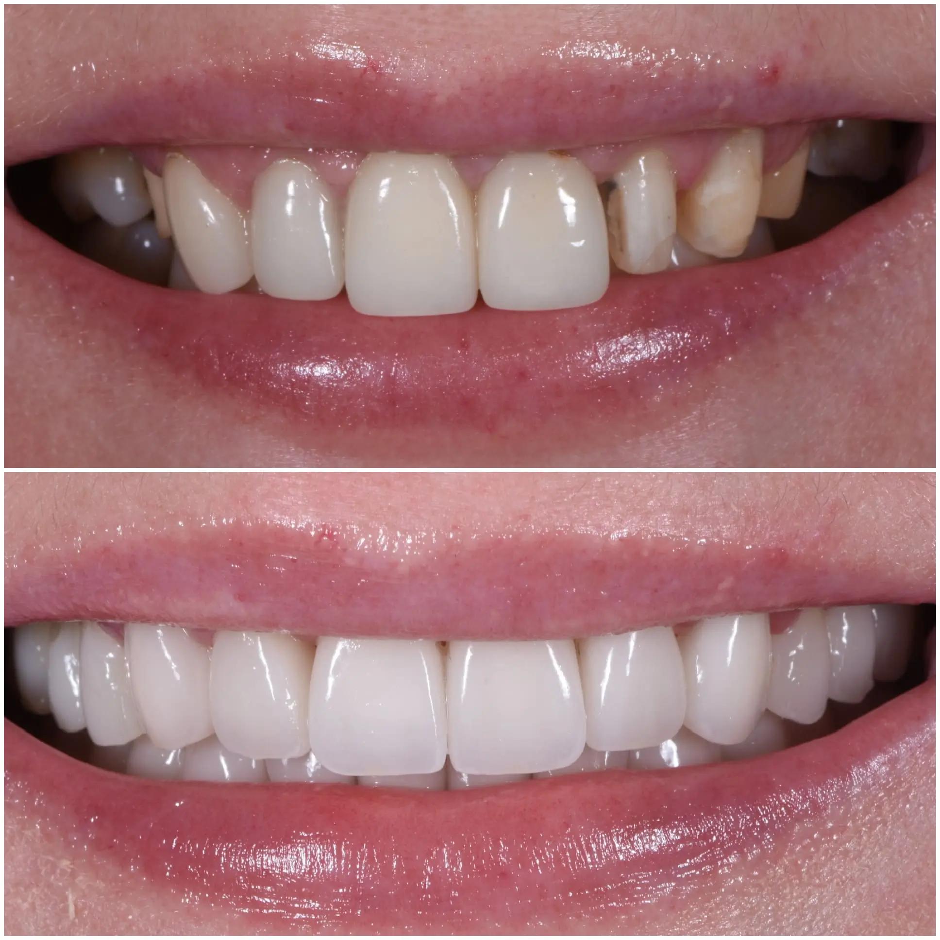 teeth before and after the procedure