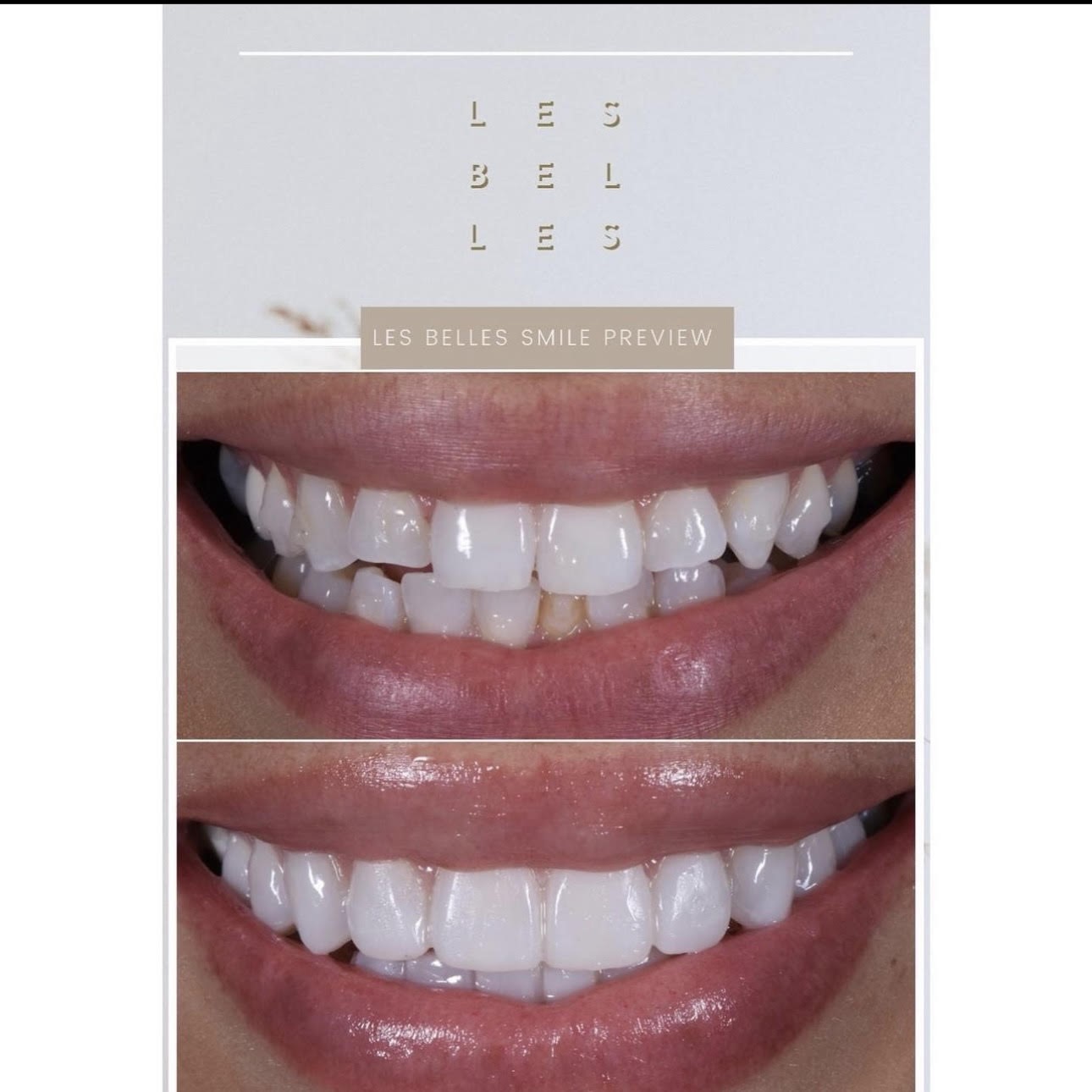 Les Bel Les, Les Belles Smile Preview. Teeth before and after Les Belles Smile Preview