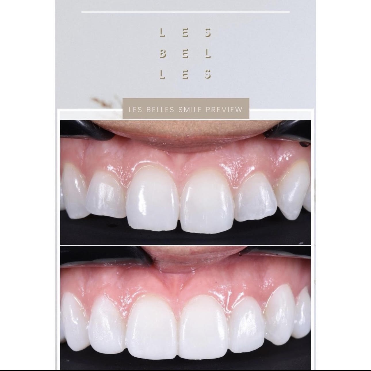 Teeth before and after Les Belles Smile Preview