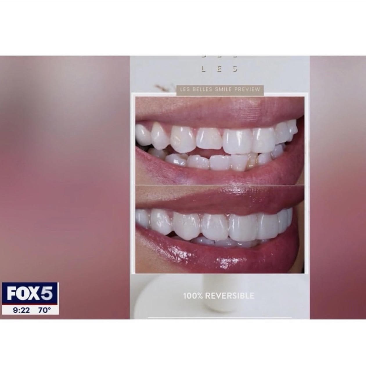 Teeth before and after Les Belles Smile Preview