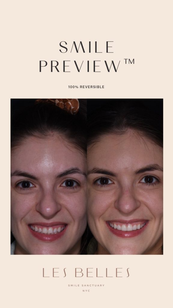 Smile Preview before and after