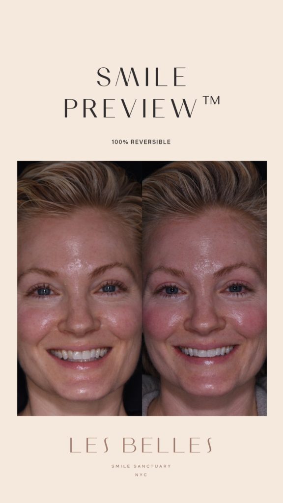Smile Preview before and after
