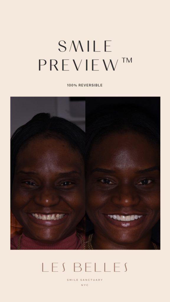 Smile Preview before and after