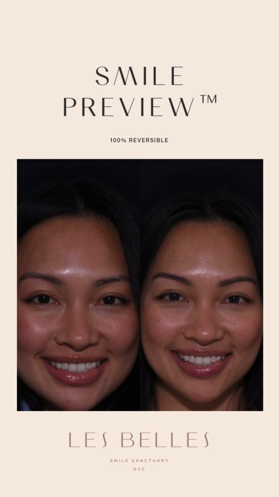 Smile Preview before and after