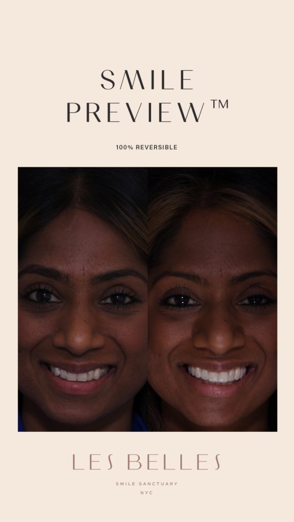 Smile Preview before and after