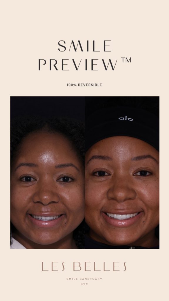 Smile Preview before and after