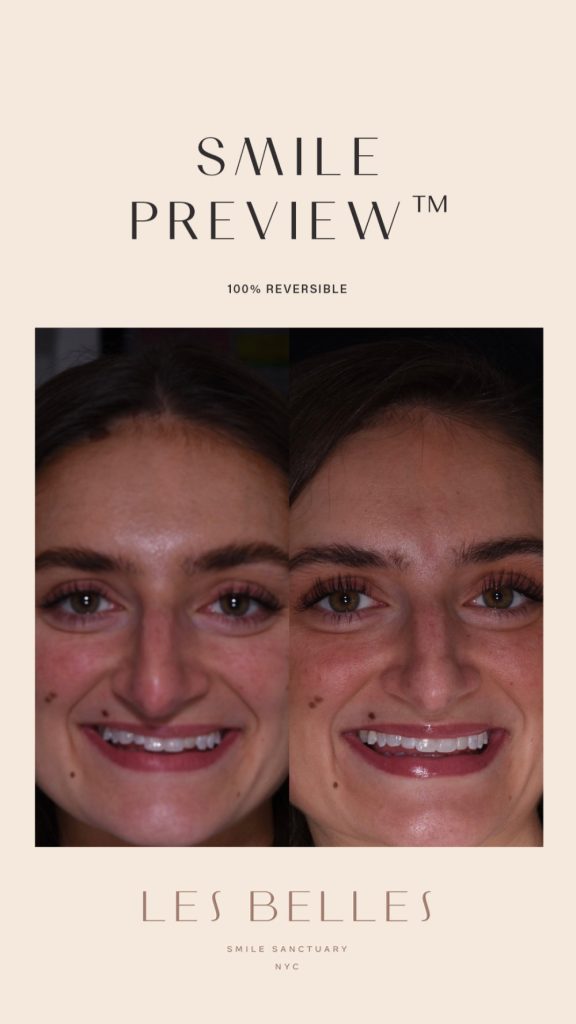 Smile Preview before and after
