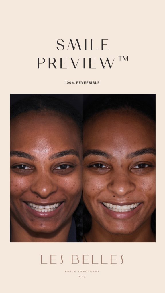 Smile Preview before and after