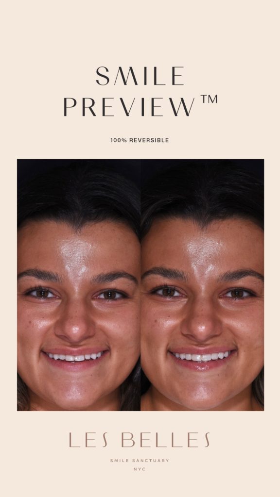 Smile Preview before and after