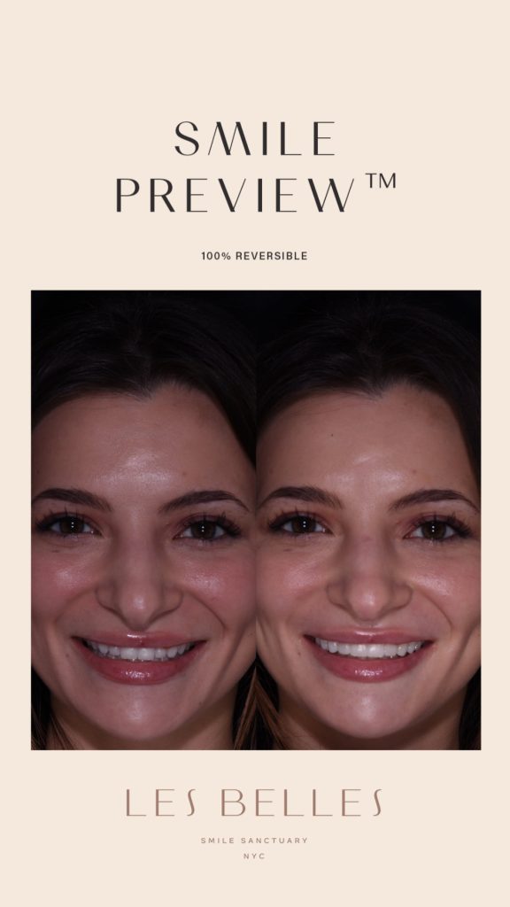 Smile Preview before and after