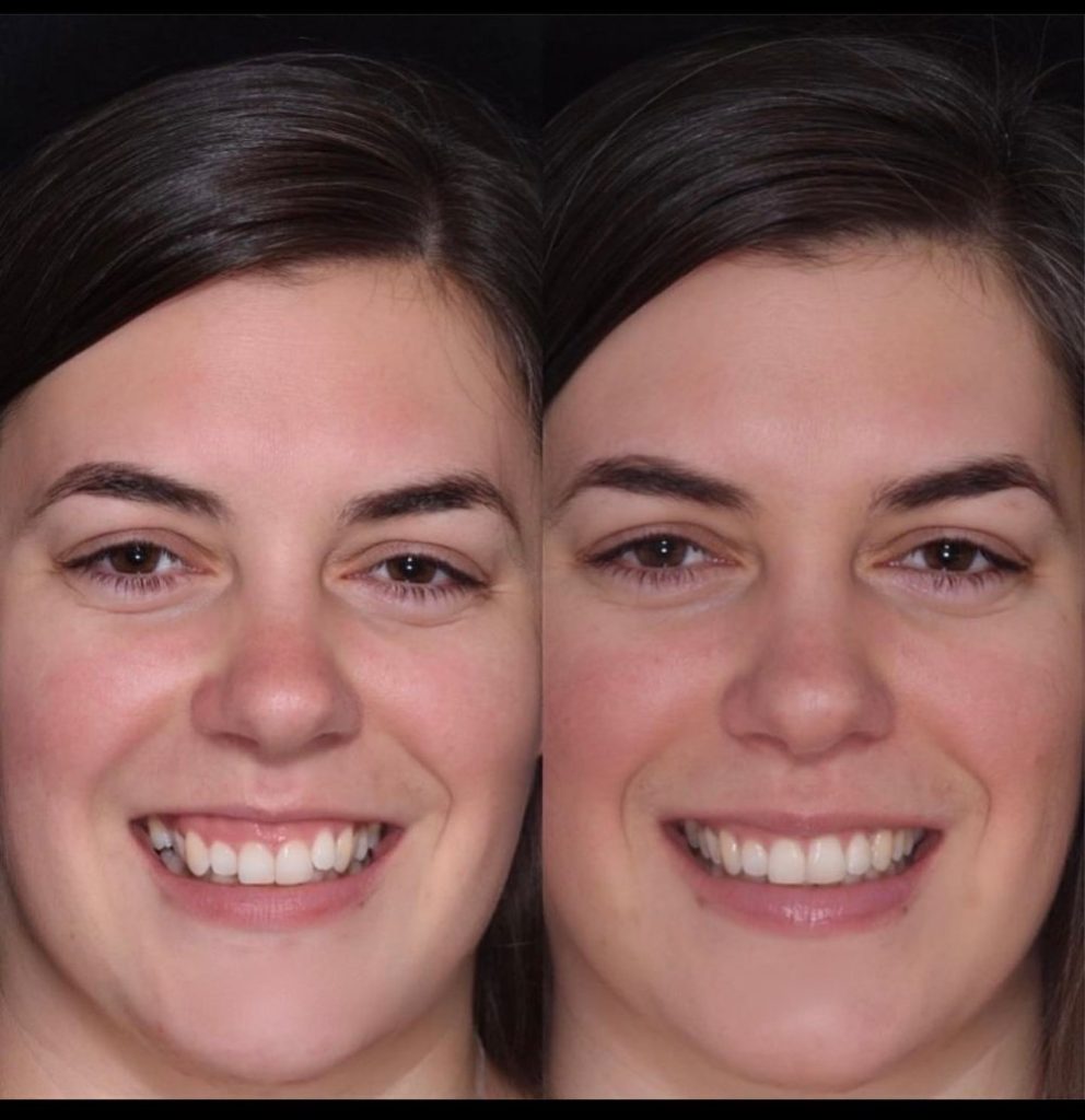Accelerated Invisalign before and after