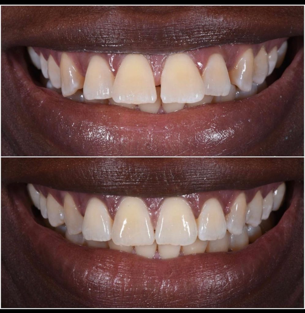 Accelerated Invisalign before and after