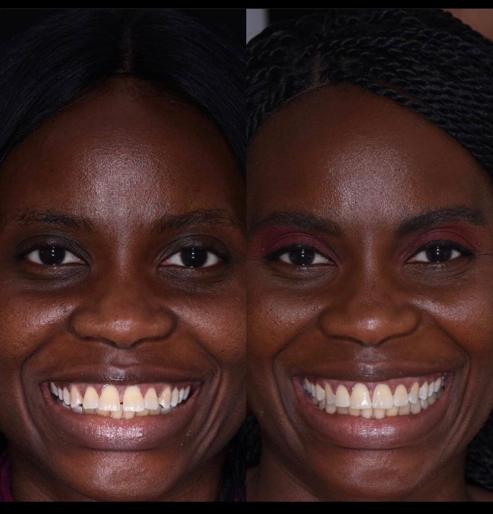 Accelerated Invisalign before and after
