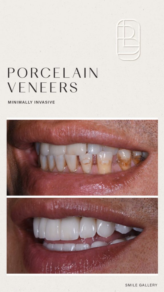Veneers before and after