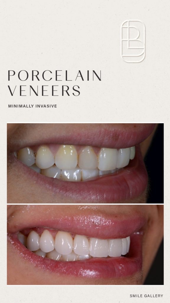 Veneers before and after