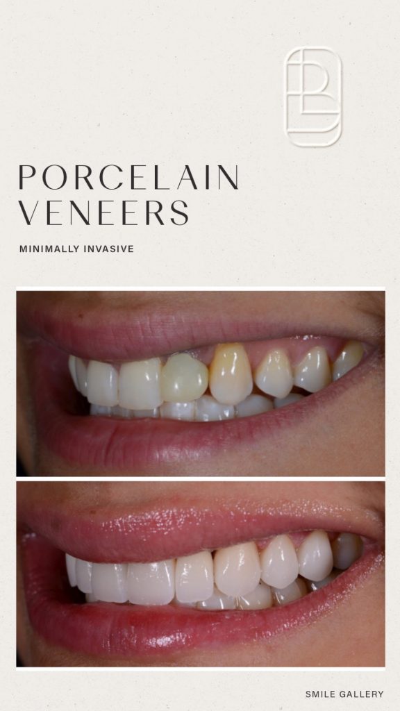 Veneers before and after
