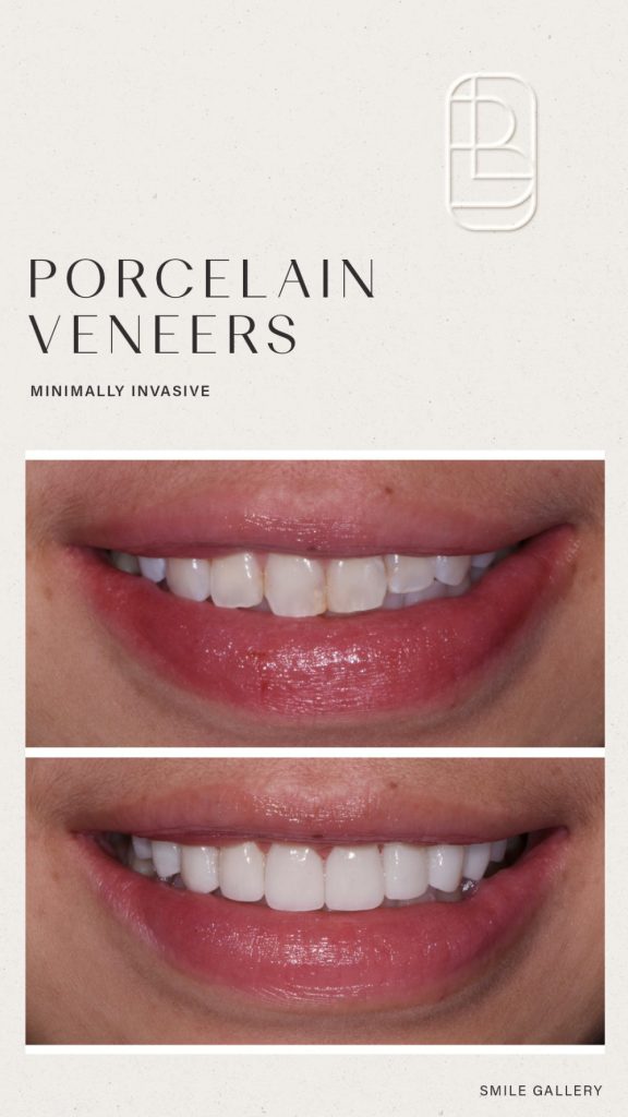 Veneers before and after