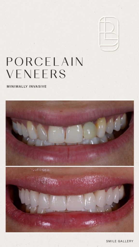 Veneers before and after