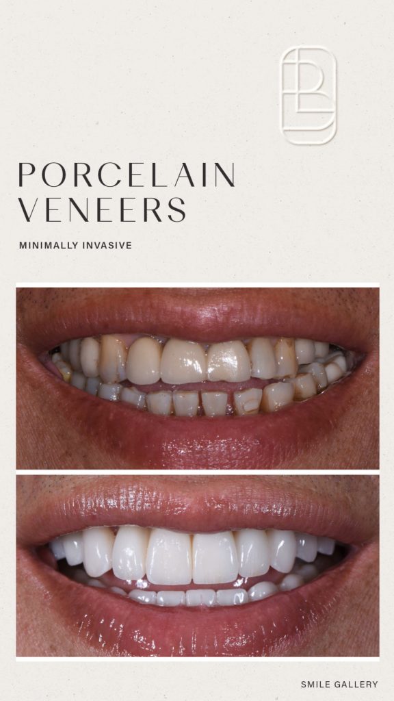 Veneers before and after
