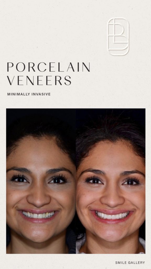 Veneers before and after