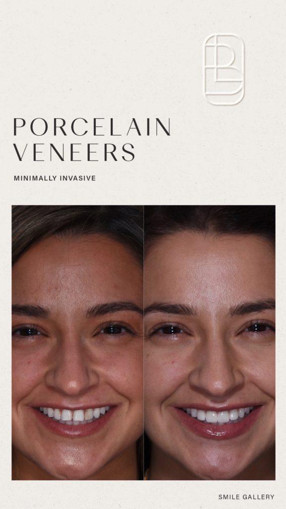 Veneers before and after