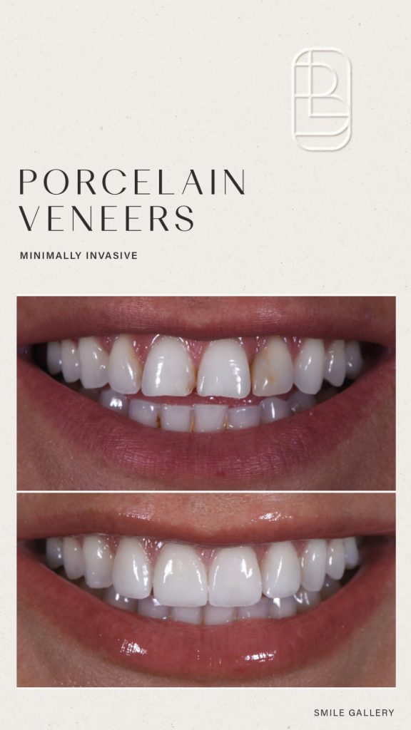 Veneers before and after