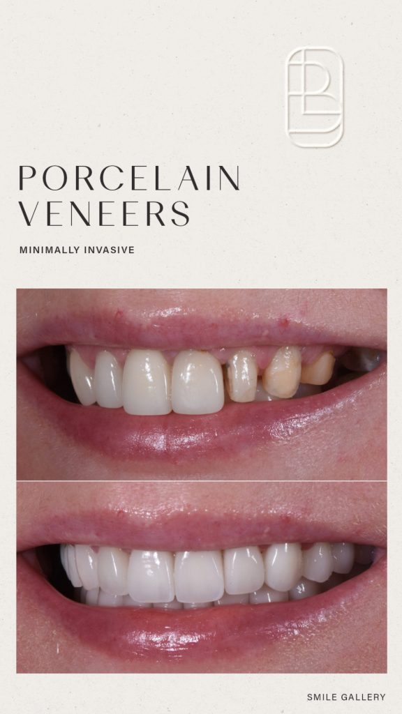 Veneers before and after