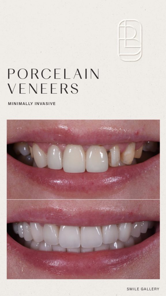 Veneers before and after