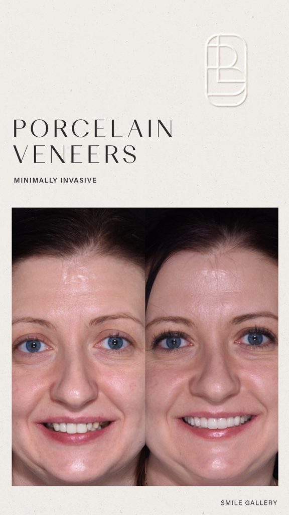 Veneers before and after