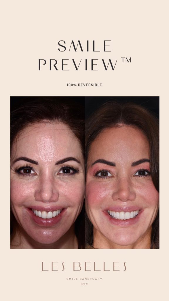 Smile Preview before and after
