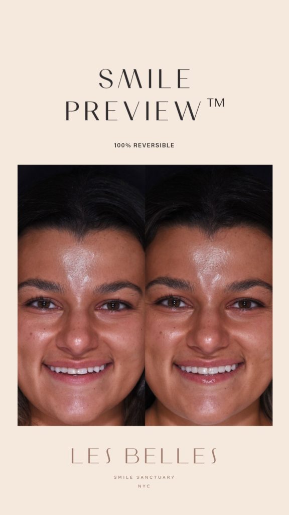Smile Preview before and after