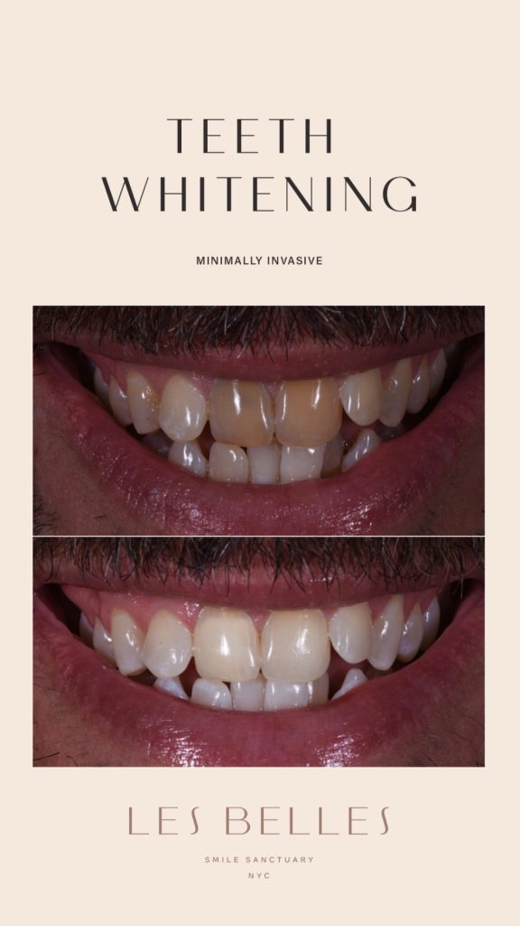 Teeth Whitening before and after