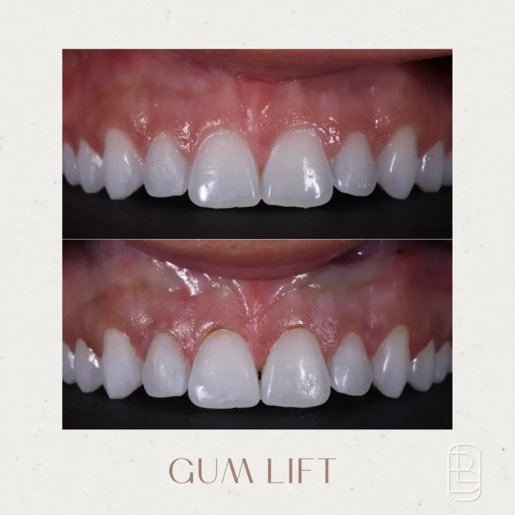 Before-and-after comparison of teeth showing results of a gum lift procedure.